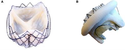 Innovative use of a self-expanding valve for valve-in-valve transcatheter mitral valve replacement: experience from a four-year single-center study